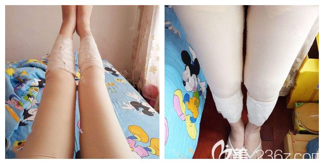 剛做完吸脂瘦大腿手術穿著塑身衣