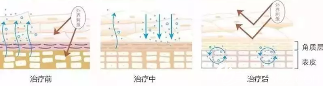 激光去紅血絲原理 激光去紅血絲原理