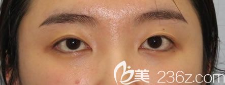 寧波薇琳整形醫(yī)院做雙眼皮術(shù)前 寧波薇琳整形醫(yī)院做雙眼皮術(shù)前