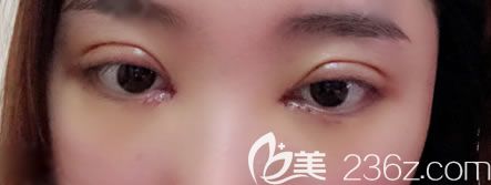 寧波薇琳雷艷莉雙眼皮<span style= 寧波薇琳雷艷莉雙眼皮<span style=