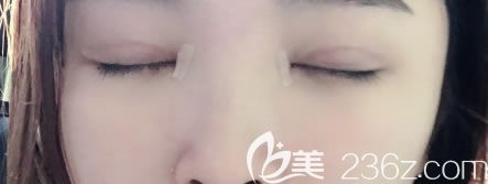 寧波薇琳雙眼皮手術(shù)疤痕恢復(fù)照片 寧波薇琳雙眼皮手術(shù)疤痕恢復(fù)照片