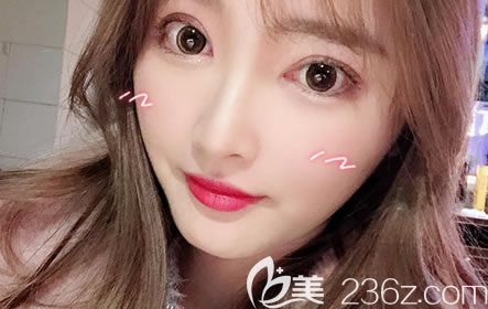 參加了寧波薇琳整形醫(yī)院22周年優(yōu)惠活動(dòng),花8千多價(jià)格找雷艷莉主任醫(yī)生做了雙眼皮和開眼角