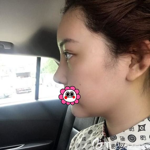 術(shù)后五天到醫(yī)院拆線效果 術(shù)后五天到醫(yī)院拆線效果