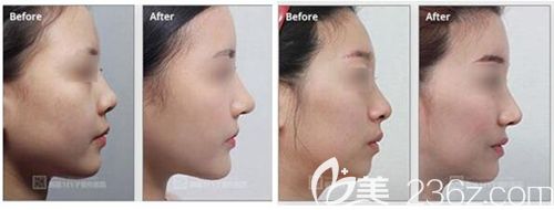 韓國MVP鼻部整形手術(shù)案例