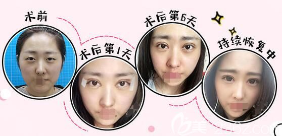 代金奎醫(yī)生雙眼皮案例