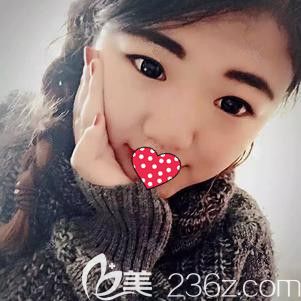 在衡水唯美做雙眼皮前是無神單眼皮 在衡水唯美做雙眼皮前是無神單眼皮