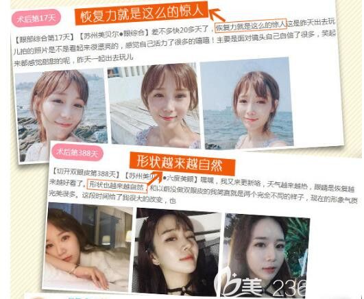 蘇州美貝爾：李智勇、譚亮雙眼皮案例