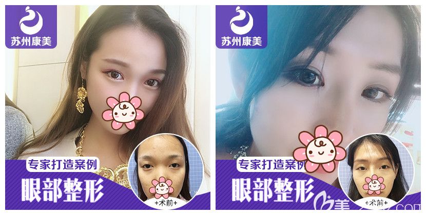 蘇州康美整形：張悅迪雙眼皮案例