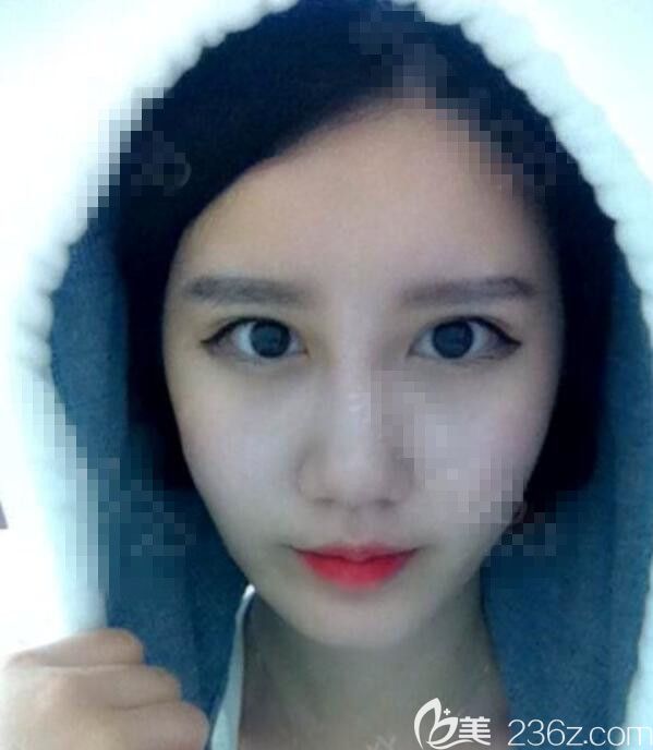 在韓國(guó)綺林整形做了隆鼻墊鼻基底埋線雙眼皮加提肌矯正路人甲從此有了更多追求者