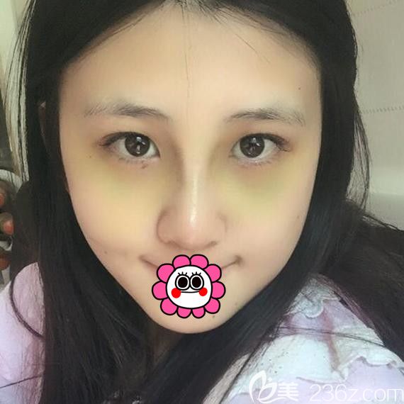哈爾濱索菲隆鼻拆線后案例