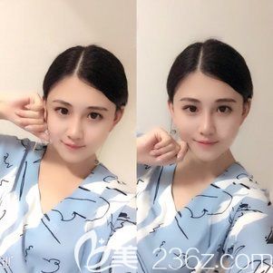 說說我到哈爾濱索菲找陳富全用耳軟骨隆鼻的心路歷程，順便整理了一份鼻整形價格表