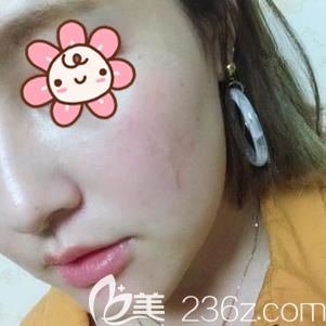 楊主任做激光祛斑術(shù)后出現(xiàn)反黑情況