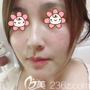 楊麗群主任幫我做激光祛斑術(shù)后即刻臉微微紅腫