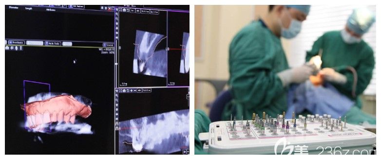 廣州廣大口腔精準(zhǔn)"即刻用"種植牙技術(shù)優(yōu)勢