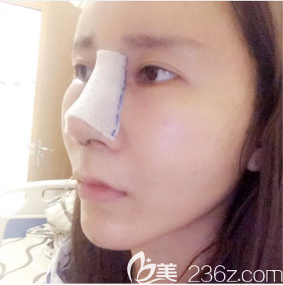 李闖肋骨鼻綜合隆鼻術(shù)后兩天<span style= 李闖肋骨鼻綜合隆鼻術(shù)后兩天<span style=