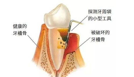 牙槽骨萎縮示意圖