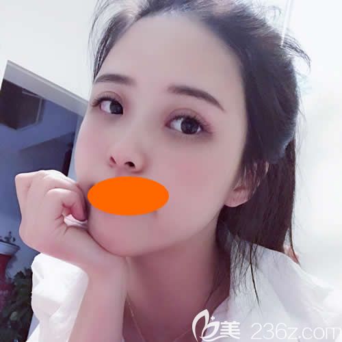 贛州華美整形路衛(wèi)國(guó)院長(zhǎng)給我割雙眼皮+隆鼻術(shù)后5天