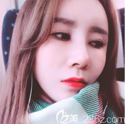 李闖院長(zhǎng)全肋骨鼻綜合隆鼻術(shù)后7天拆線 李闖院長(zhǎng)全肋骨鼻綜合隆鼻術(shù)后7天拆線