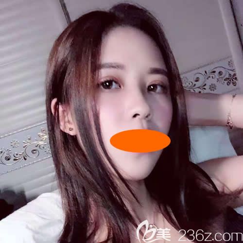 贛州華美整形路衛(wèi)國(guó)院長(zhǎng)給我割雙眼皮+隆鼻術(shù)后第26天