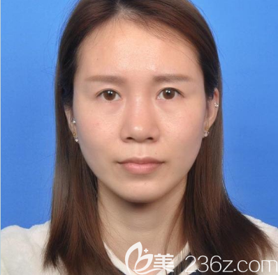 在廣州藝美做鼻綜合隆鼻前的照片 在廣州藝美做鼻綜合隆鼻前的照片