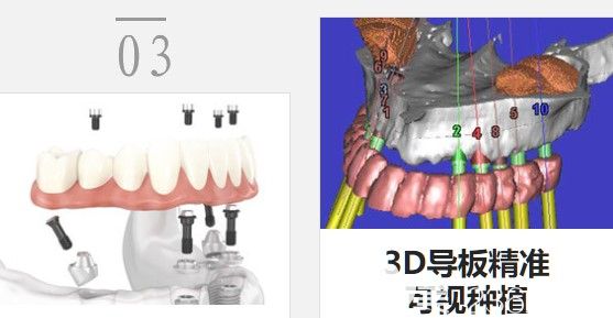 3D導(dǎo)板精準(zhǔn)可視種植技術(shù) 3D導(dǎo)板精準(zhǔn)可視種植技術(shù)