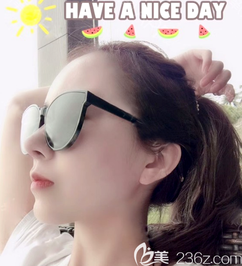 廣州藝美李闖做的全肋骨鼻綜合隆鼻<span style= 廣州藝美李闖做的全肋骨鼻綜合隆鼻<span style=