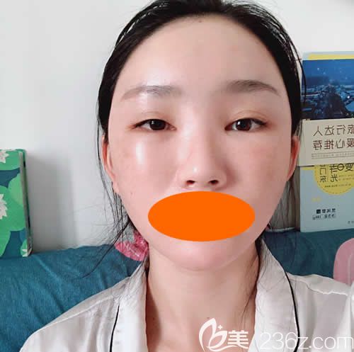 找贛州華美整形路衛(wèi)國做了自體脂肪填充全臉術(shù)后第4天