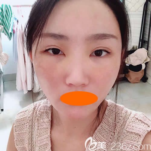 找贛州華美整形路衛(wèi)國做了自體脂肪填充全臉術(shù)后5天