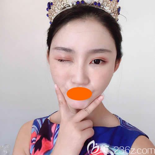 找贛州華美整形路衛(wèi)國做了自體脂肪填充全臉術(shù)后第37天