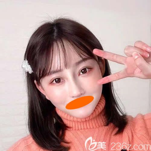 一個月前找贛州華美整形路衛(wèi)國做了自體脂肪填充全臉，朋友都說術(shù)后效果堪比川劇變臉哦