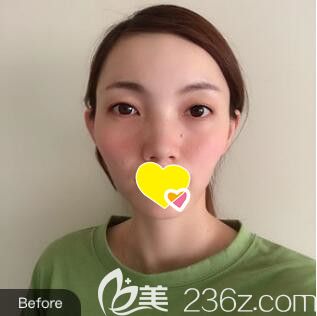 在大連沙醫(yī)生整形醫(yī)院做面部自體脂肪填充術(shù)前照 在大連沙醫(yī)生整形醫(yī)院做面部自體脂肪填充術(shù)前照