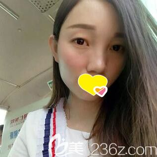 做自體脂肪填充面部術(shù)后18天效果 做自體脂肪填充面部術(shù)后18天效果