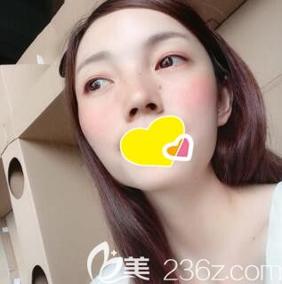 做完自體脂肪填充面部術(shù)后34天效果 做完自體脂肪填充面部術(shù)后34天效果