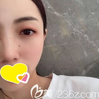 在大連沙醫(yī)生整形醫(yī)院做完自體脂肪填充面部術(shù)后42天效果 在大連沙醫(yī)生整形醫(yī)院做完自體脂肪填充面部術(shù)后42天效果