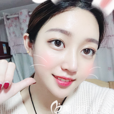 朋友們看了我找廣州海峽李希軍做的黃金希望三角鼻綜合隆鼻效果后贊不絕口