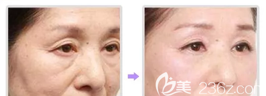 北京米蘭柏羽麗都液態(tài)眼霜小冰瓶祛魚尾紋案例