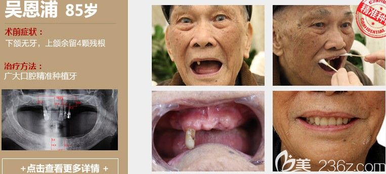 廣大口腔精準(zhǔn)種植牙案例效果