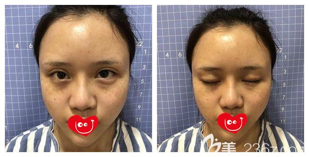 做完雙眼皮術(shù)后半年腫脹明顯 做完雙眼皮術(shù)后半年腫脹明顯