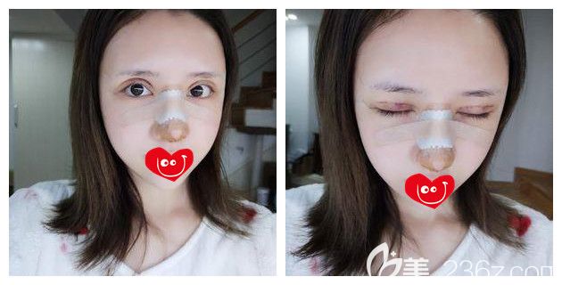 剛做完雙眼皮修復(fù)+硅膠隆鼻術(shù)后即刻 剛做完雙眼皮修復(fù)+硅膠隆鼻術(shù)后即刻