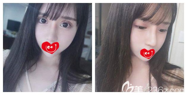 術(shù)后十天雙眼皮和鼻子恢復(fù)情況 術(shù)后十天雙眼皮和鼻子恢復(fù)情況