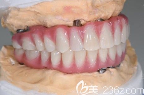 廣州廣大口腔劉國輝醫(yī)生給我定制的全口牙冠 廣州廣大口腔劉國輝醫(yī)生給我定制的全口牙冠