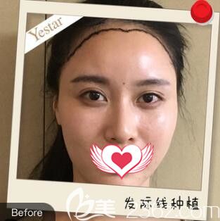 做發(fā)際線種植術(shù)前照 做發(fā)際線種植術(shù)前照
