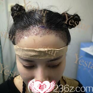 種植發(fā)際線術(shù)后即刻<span style= 種植發(fā)際線術(shù)后即刻<span style=