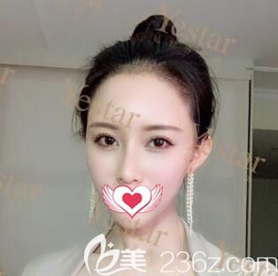 種植發(fā)際線術(shù)后半個(gè)月<span style= 種植發(fā)際線術(shù)后半個(gè)月<span style=