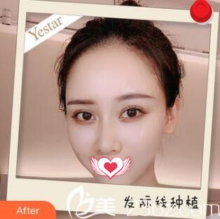 種植發(fā)際線可靠嗎？用我在長(zhǎng)沙藝星整形做發(fā)際線種植效果告訴你答案！