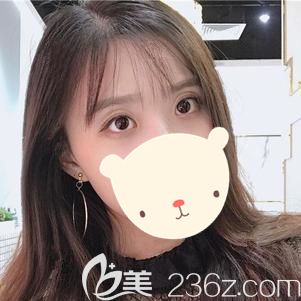 朱醫(yī)生做眼部綜合整形術(shù)后56天雙眼皮和眼角恢復(fù)自然