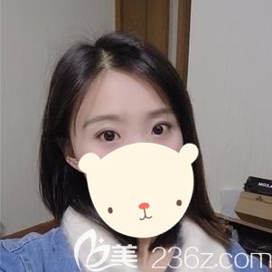 做眼綜合整形術(shù)后12天眼部腫脹消除眼角疤痕漸消