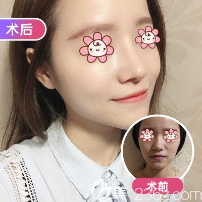 武漢美基元做鼻綜合整形術前術后對比效果