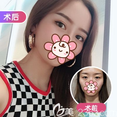 美基元雙眼皮整形真人案例術后恢復情況