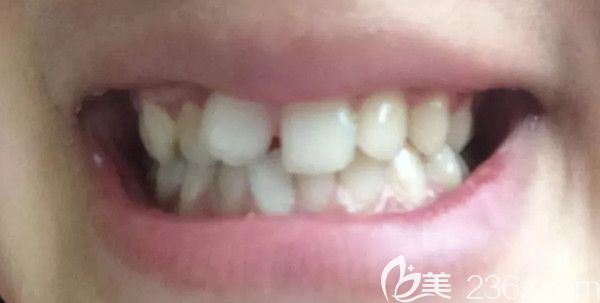 矯正前門牙歪+牙縫大的照片 矯正前門牙歪+牙縫大的照片